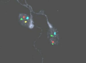 Sperm Chromosome Aneuploidy