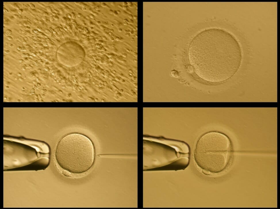 Intracytoplasmic Sperm Injection (ICSI)