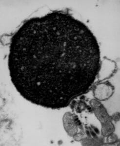 Round Headed Sperm Syndrome